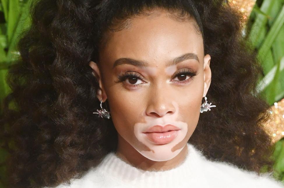 Winnie Harlow, la polemica prende il volo