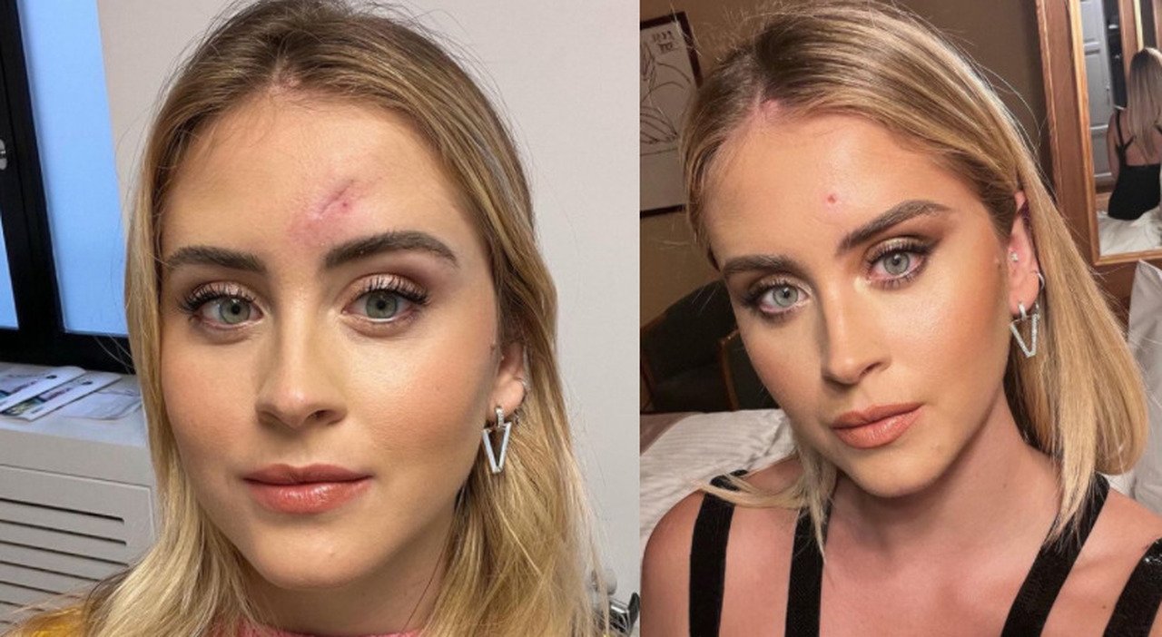 Valentina Ferragni dopo l’operazione: “È un tumore maligno della pelle”